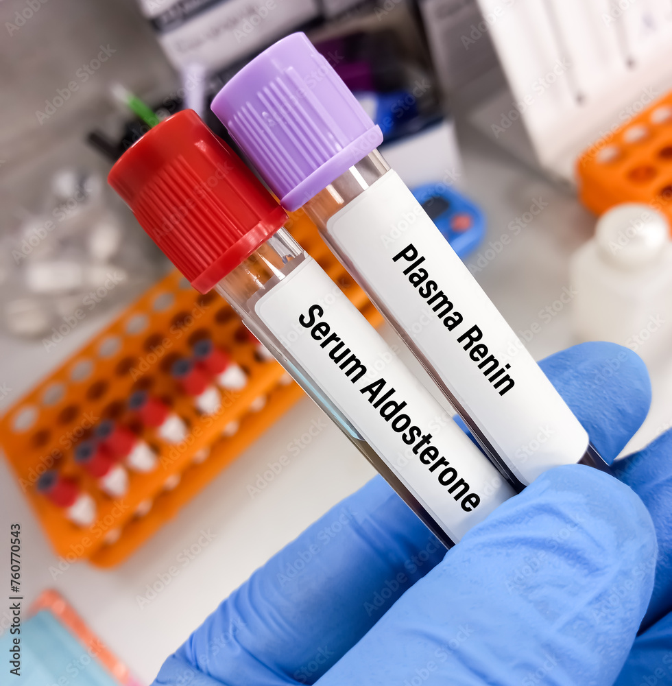 Wall mural Blood samples for Serum Aldosterone and Plasma Renin test.