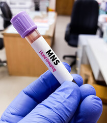 Technologist hold blood sample for MNS blood group system. Sugar-bearing proteins called glycophorins.