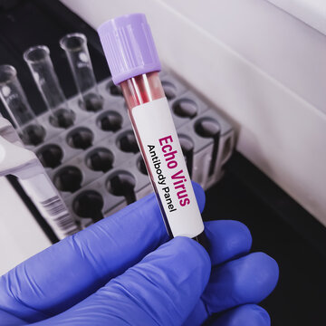 Blood sample for Echo virus antibody panel test, polyphyletic group of viruses, single-stranded RNA enterovirus, belonging to the Picornaviridae family.