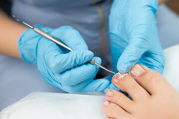 A podologist examines toenails affected by a fungal infection. Medical pedicure in the clinic.