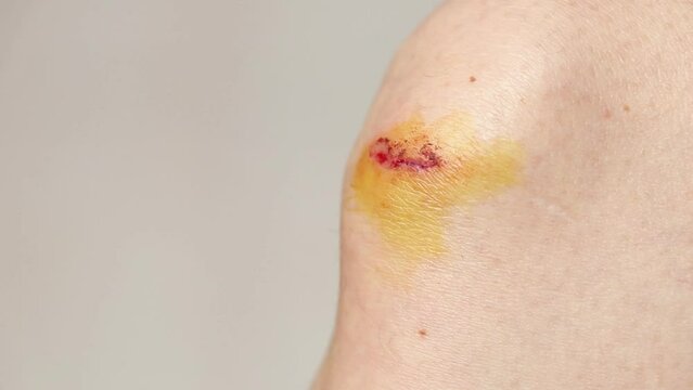 Close-up of a wound with blood on a girl's knee after a fall, accident and injury