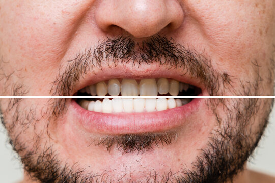 Man's teeth before and after whitening and alignment (braces). Oral care