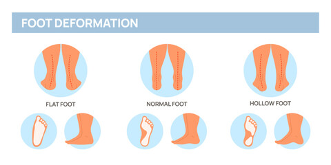Foot deformation poster. Medical scheme with leg curvature types. Flat, hollow and normal feet. Anatomical pathology. Orthopedic medicine. Disease infographic. Garish vector concept - obrazy, fototapety, plakaty