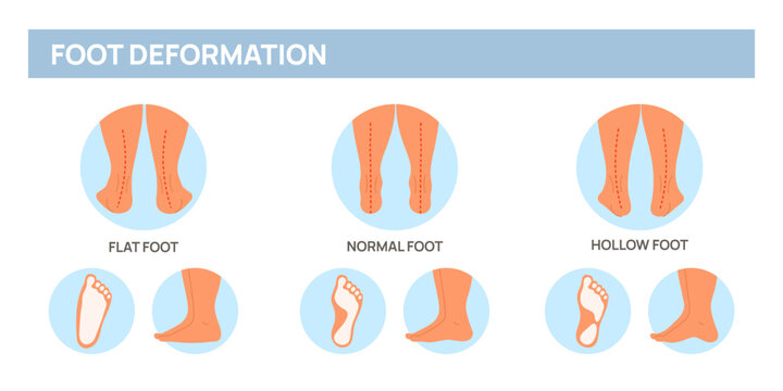 Foot deformation poster. Medical scheme with leg curvature types. Flat, hollow and normal feet. Anatomical pathology. Orthopedic medicine. Disease infographic. Garish vector concept