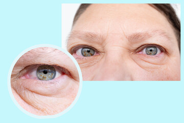 close-up part face middle-aged woman in two versions, puffiness under lower eyelid, wrinkles on...