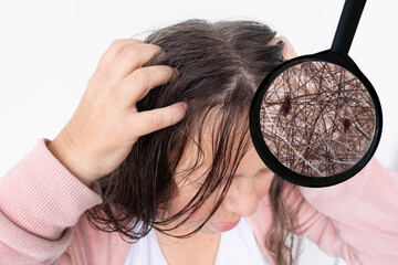woman scratching head, close-up hair lice, feeling itchy and possibly having lice, showing effects...