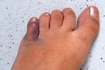 close-up part of female foot, subcutaneous hemorrhage on little toe, concept of fracture, bruise, redness in area of injury, soft tissue edema, industrial or domestic injury