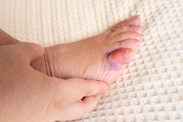 close-up part of female foot, subcutaneous hemorrhage on little toe, concept of fracture, bruise,...