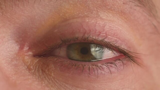 Close up annoyed red blood eye of man affected by conjunctivitis or after flu, cold or allergy. Male with vision problems, nearsightedness, eyelids inflammation and conjunctivitis eye pupil and iris