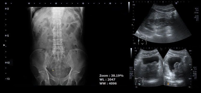 x-ray images of spine or spinal and urinary bladders or bladder for check prostate, gland or prostatic.