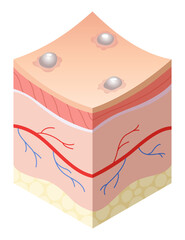 Skincare medical concept. Problems in cross-section of human skin horizontal layers structure. Anatomy illustrative model unhealthy layer of skin