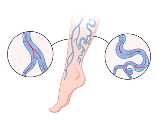 Varicose veins. Blue blood vessel visible through the skin, abnormally swollen leg. Vascular disease diagnostic and treatment. Venous insufficiency medical disease