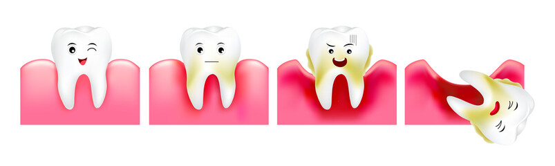 Step of periodontal disease. Healthy tooth and gingivitis. Dental care concept. Illustration