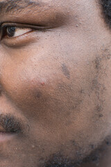 Brown skin with dark spots, hyperpigmentation on brown skin, african american man with skin...