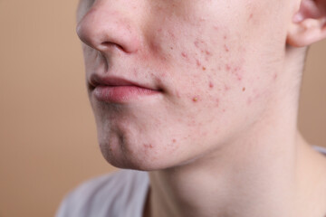 Fototapeta premium Young man with acne problem on beige background, closeup