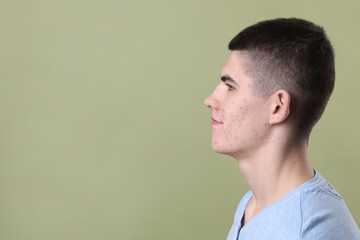 Young man with acne problem on olive background. Space for text