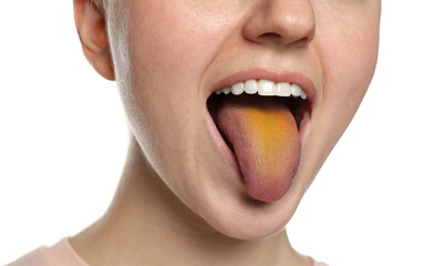 Gastrointestinal diseases. Woman showing her yellow tongue on white background, closeup