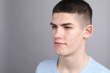 Fototapeta premium Young man with acne problem on grey background. Space for text