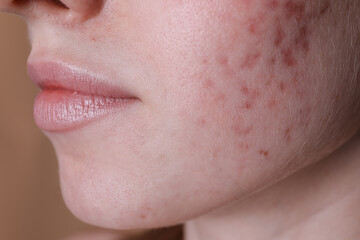Young woman with acne problem on beige background, closeup