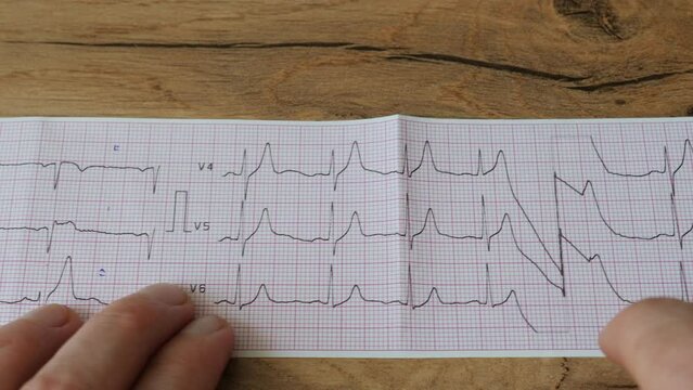 A cardiologist analyzes the electrocardiogram of a patient with heart abnormalities. ECG  or EKG