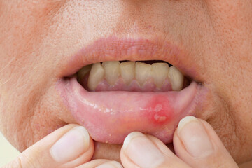 stomatitis in mouth closeup, close-up on the lip with aphthous stomatitis, treatment of inflammation of the oral mucosa
