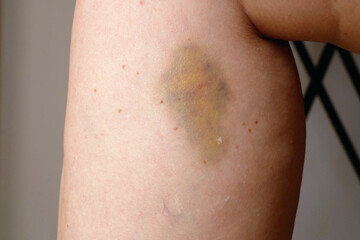 Closeup of bruise occur on middle aged woman leg. Varicose veins illness  and bruise treatment with medical ointment