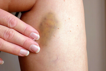 Closeup of bruise occur on middle aged woman leg. Varicose veins illness  and bruise treatment with...