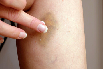 Closeup of bruise occur on middle aged woman leg. Varicose veins illness  and bruise treatment with medical ointment - obrazy, fototapety, plakaty
