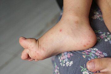 Close up view of child's feet infected with hand feet and mouth disease or HFMD originating from...