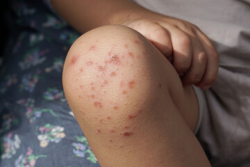 knee of a child infected with hand feet and mouth disease or HFMD originating from enterovirus or...