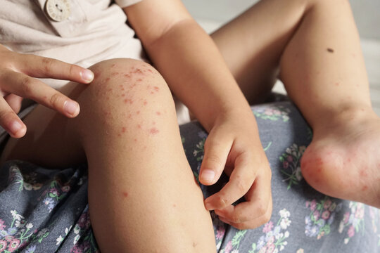 Boy showing his knee infected with hand feet and mouth disease or HFMD originating from enterovirus or coxsackie virus, close up view zoom shot.