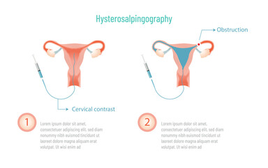 Hysterosalpingography process 