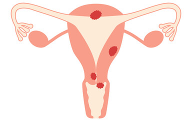 Diagrammatic illustration of cervical cancer, anatomy of the uterus and ovaries