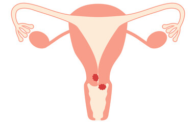 Diagrammatic illustration of cervical cancer, anatomy of the uterus and ovaries