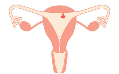 Diagrammatic illustration of endometrial polyps, anatomy of the uterus and ovaries