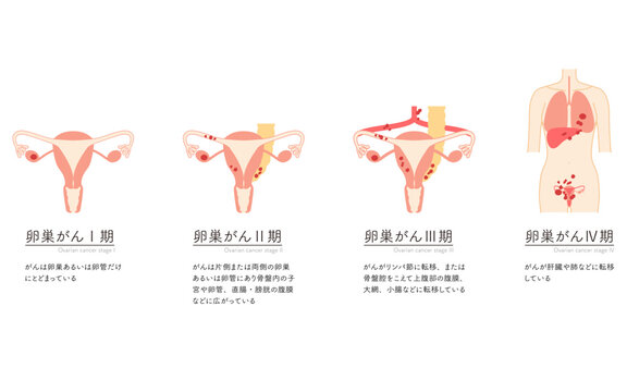 Diagrammatic illustration of stage I ovarian cancer, anatomy of the uterus and ovaries
