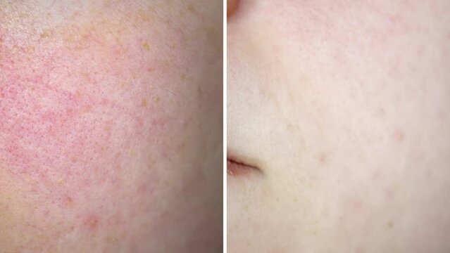 Skin Before and After. Skin Treatment Result Visualisation in Split Screen. Problematic Skin With Redness and Enlarged. Pores Next to a Light and Healthy Skin.