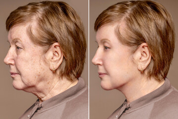 Portrait of an elderly woman before and after skin tightening and cosmetic procedures.