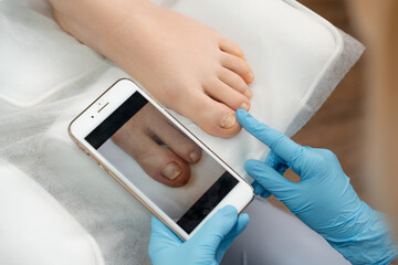 Podologist compares the results after ingrown toenails removal using a photo on a smartphone - obrazy, fototapety, plakaty