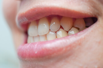 Close up photo of a woman's canine teeth in smiling mouth