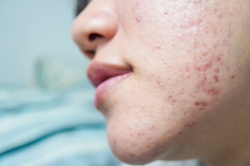 Close up detail photo of The face of an Asian woman who has many pimples on her cheeks. Hormonal...