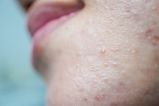 Close up detail photo of The face of an Asian woman who has many pimples on her cheeks. Hormonal acne, puberty and before menstruation. 