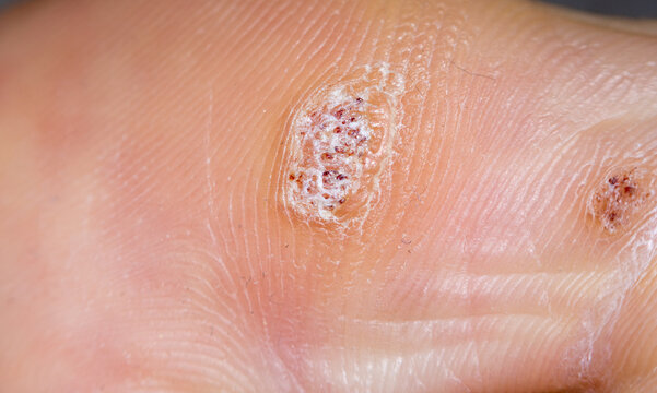 Plantar wart close up on the bottom of a big toe caused by the human papillomavirus, or HPV