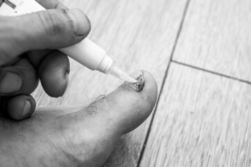 applying an antifungal agent to the toenail of the affected by the fungus close-up, the foreground...