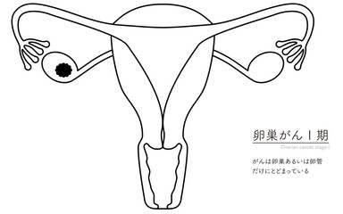 卵巣がんI期の図解イラスト、子宮・卵巣の解剖図