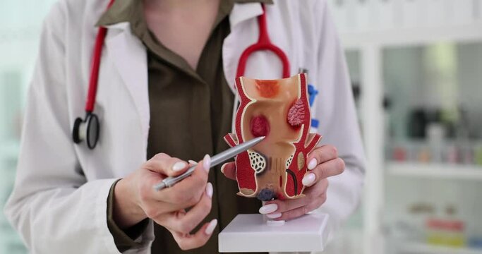 Proctologist shows irrigated hemorrhoids in human rectum