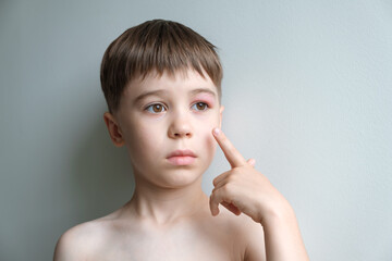 The boy points at his swollen eye from an insect bite. Close-up portrait of child with angioedema....