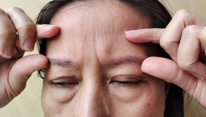 close up of a person with a headache, showing the flabbiness and wrinkle, swelling and ptosis...