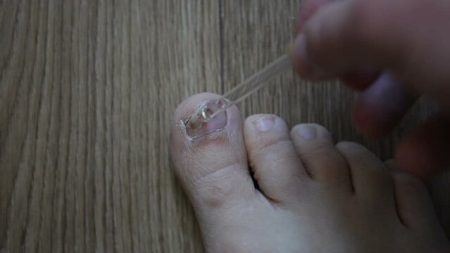 Onycholysis - detachment of the nail from the soft tissues of the finger. Disease of the nail plate on the big toe. Toenail fungus treatment.