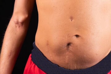 A man's body after kidney transplant surgery, with a fistula on his arm from hemodialysis.